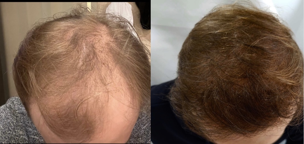 Tipuri de Alopecie și cauzele căderii părului