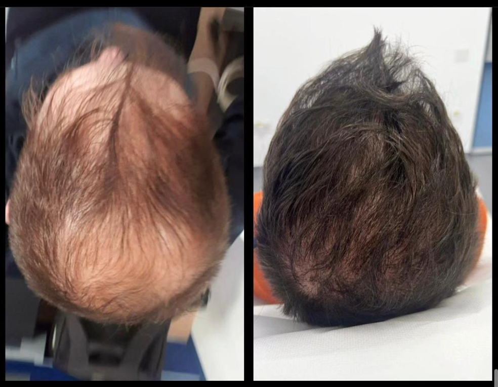 Alopecia androgenică: De ce ne cade părul?