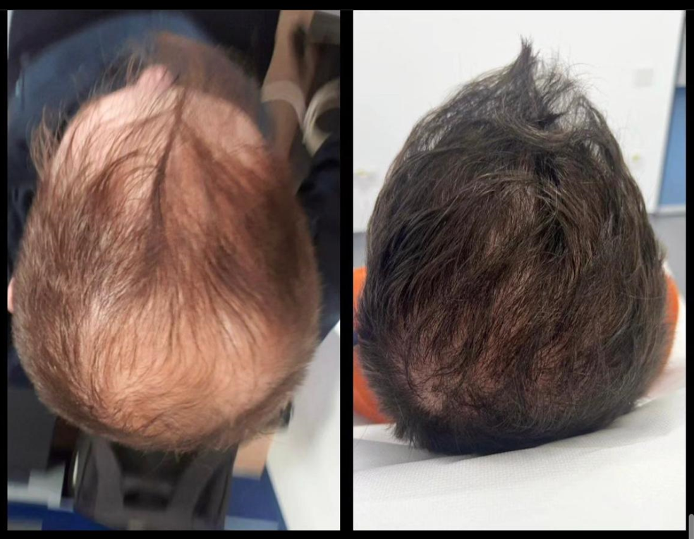 alopecie androgenica: De ce ne cade părul?